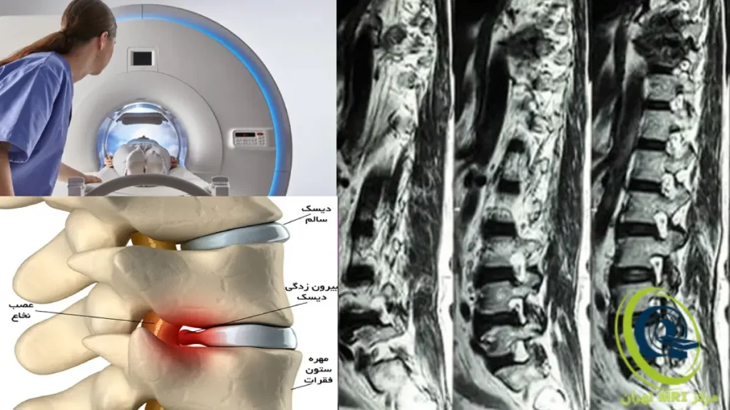 mri کمر تصویری از ام آر آی کمر - تصویر انجام ام ار ای توسط اپراتور و همچنین توضیح بیرون زدگی و فتق دیسک کمر