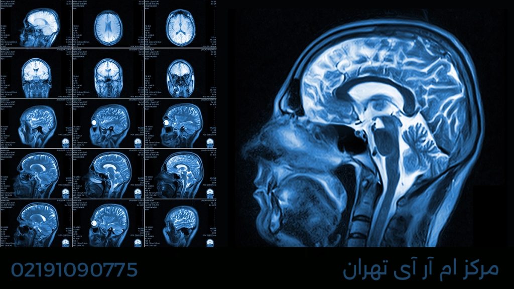 نماهای مختلف از تصویر ام آر آی مغزی به همراه شماره تماس مرکز ام آر ای تهران 