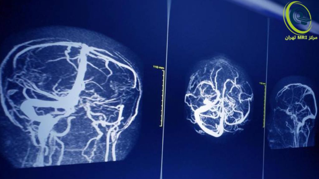 جواب ام آر وی مغزی برای بررسی احتمال وجود لخته های خونی در مغز 