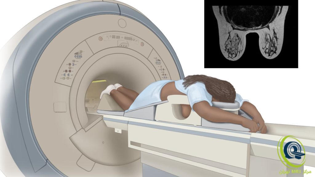 breast-mri-scan تصویری از ام آر آی پستان و عکس مربوط به جواب آن