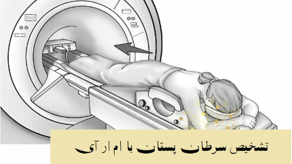 تشخیص سرطان پستان با ام آر آی بهترین روش غربالگری سرطان برست