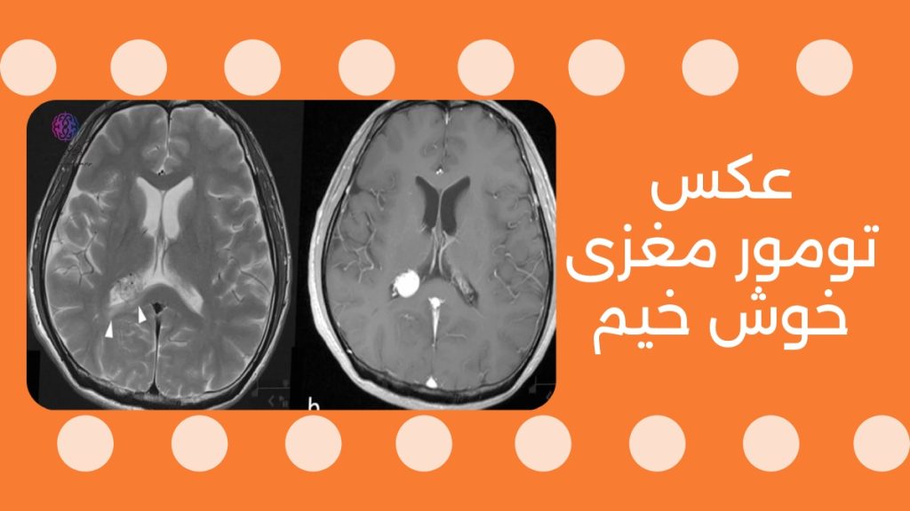 عکس تومور مغزی خوش خیم 