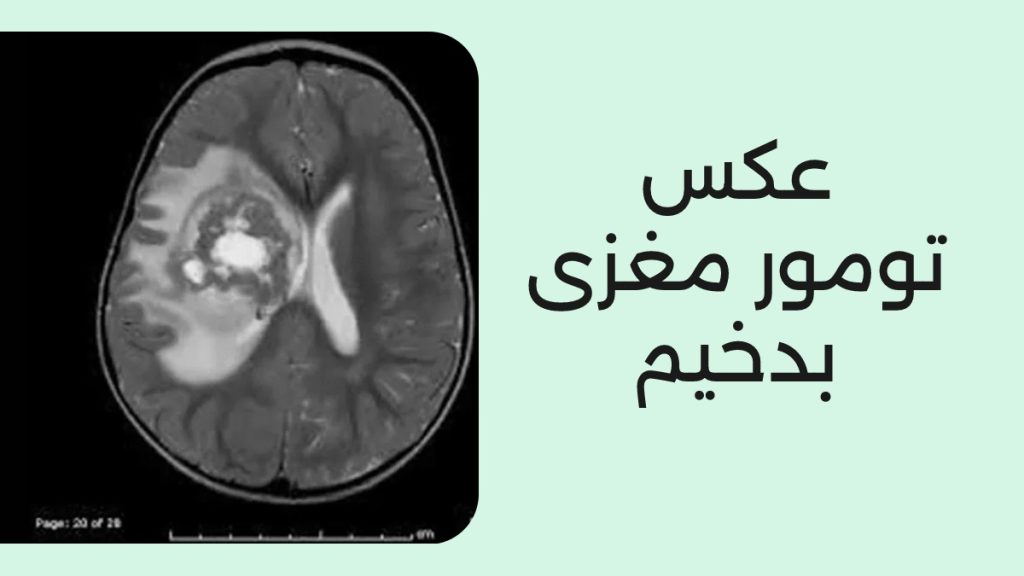 عکس تومور مغزی بدخیم 